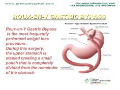 Roux-en-Y Gastric Bypass is the most frequently performed weight loss procedure 