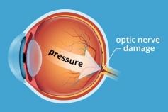 World #Glaucoma Week starts from today (March 6 - March 12)
Glaucoma is often described as the ‘silent thief of sight’ for it slowly grows and damages the optic nerve. World Glaucoma Week happens to be a global opportunity to mark this severe eye condition and the importance of eye care.
Read our blog on World Glaucoma Week and also see what Dr. Rajat Anand, Senior Consultant - #Ophthalmology has to say on this occasion at the below link:
http://metrogroupofhospitals.blogspot.in/…/know-about-glauc…