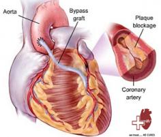 #WorldHeartDay is around the corner (29th September). We have initiated a Knowledge Sharing Series on heart diseases and conditions to empower you with knowledge to take care of your heart. Let's start with Coronary Artery Diseases (CAD's).

#CoronaryArteryDisease is also known by the name of coronary heart disease. It is one of the serious conditions as the arteries get blocked because of the formation and deposition of plaque. Read our blog at the following link:
http://bit.ly/2hwNUNB