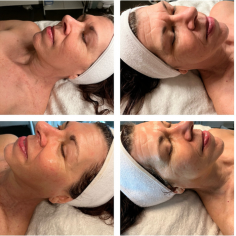 A dermaplane facial is a popular skincare treatment that involves exfoliating the skin to remove dead skin cells and fine vellus hair, commonly known as "peach fuzz." This procedure is performed using a sterile surgical scalpel, which gently glides over the skin's surface, revealing a smoother, brighter complexion. The benefits of a dermaplane facial include improved skin texture, enhanced product absorption, and a more radiant appearance. It is suitable for various skin types and can be an excellent option for those seeking a quick and effective way to rejuvenate their skin. With no downtime required, clients can enjoy immediate results.