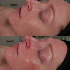 If you're searching for a dermaplaning facial near you, this treatment offers an effective way to achieve smooth, radiant skin. Dermaplaning involves the gentle exfoliation of the skin using a sterile surgical scalpel, which removes dead skin cells and fine hair, enhancing your complexion's texture and brightness. This facial is suitable for all skin types and provides immediate results with minimal downtime. By choosing a local provider for your dermaplaning facial, you can enjoy personalized care and expert techniques tailored to your skin's needs. Discover how a dermaplaning facial can rejuvenate your skin and boost your confidence today!