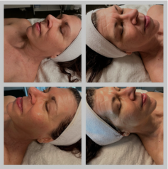 Dermaplaning is a popular facial treatment that involves exfoliating the skin by removing dead skin cells and peach fuzz. After the procedure, your skin feels smoother, looks brighter, and has a more youthful glow. But how long does dermaplaning last? Typically, the results last around 3 to 4 weeks, depending on your skin type and how quickly your skin renews itself. For optimal results, it’s recommended to undergo dermaplaning treatments every 4 weeks. Consistent care, such as moisturizing and using sunscreen, can help prolong the effects and maintain smoother skin for longer.